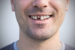 can-a-broken-tooth-be-saved-without-extraction