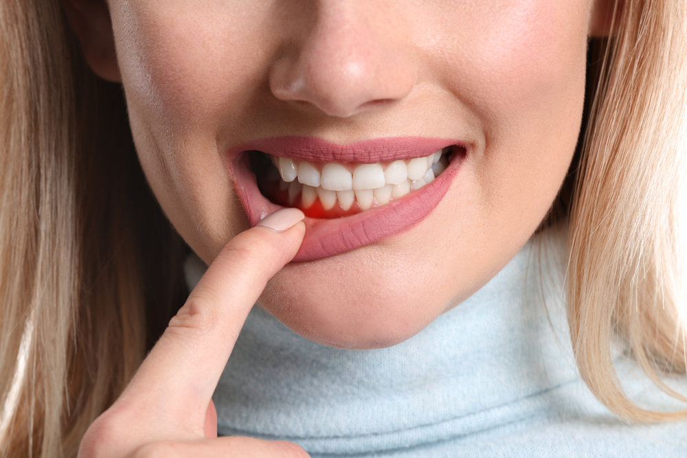 Common Signs of Gum Disease