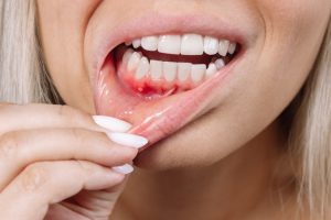 how can you stop bleeding gums quickly