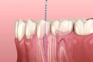 Root Canal Therapy in Grande Prairie