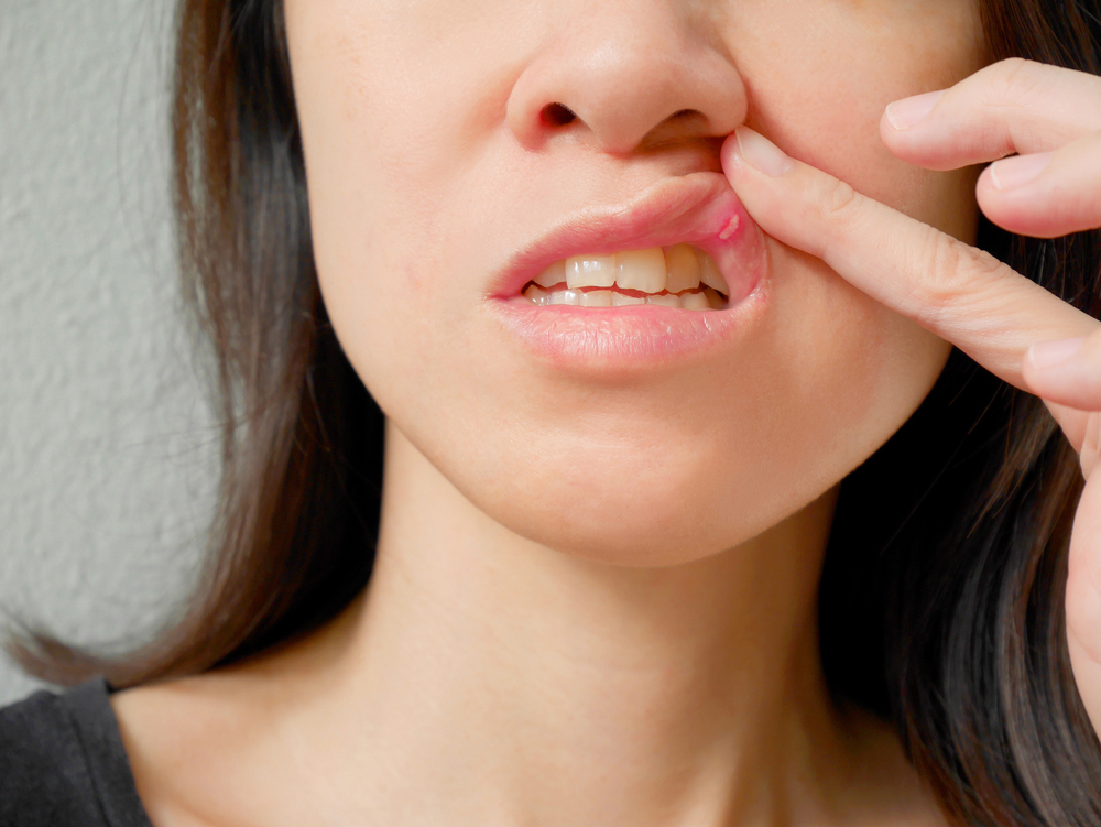 How to Treat Mouth Sores