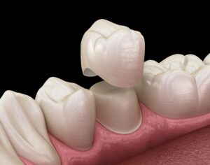 7 Tips to Care for Your Dental Crowns