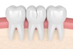 chipped and broken teeth