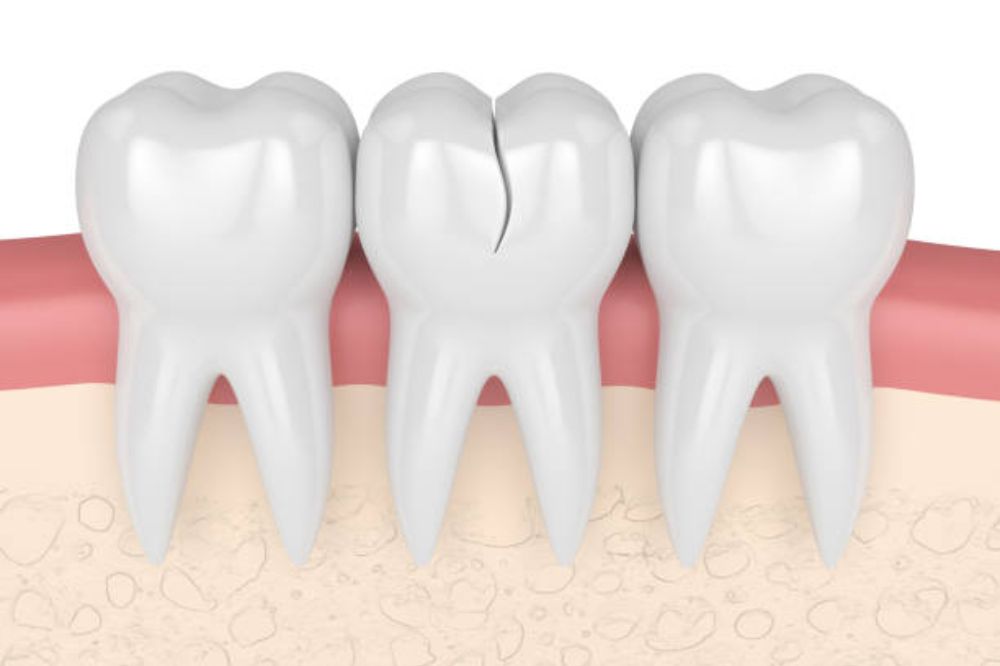 chipped and broken teeth