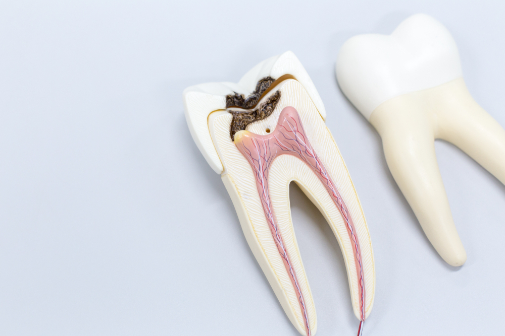 What Is a Root Canal?