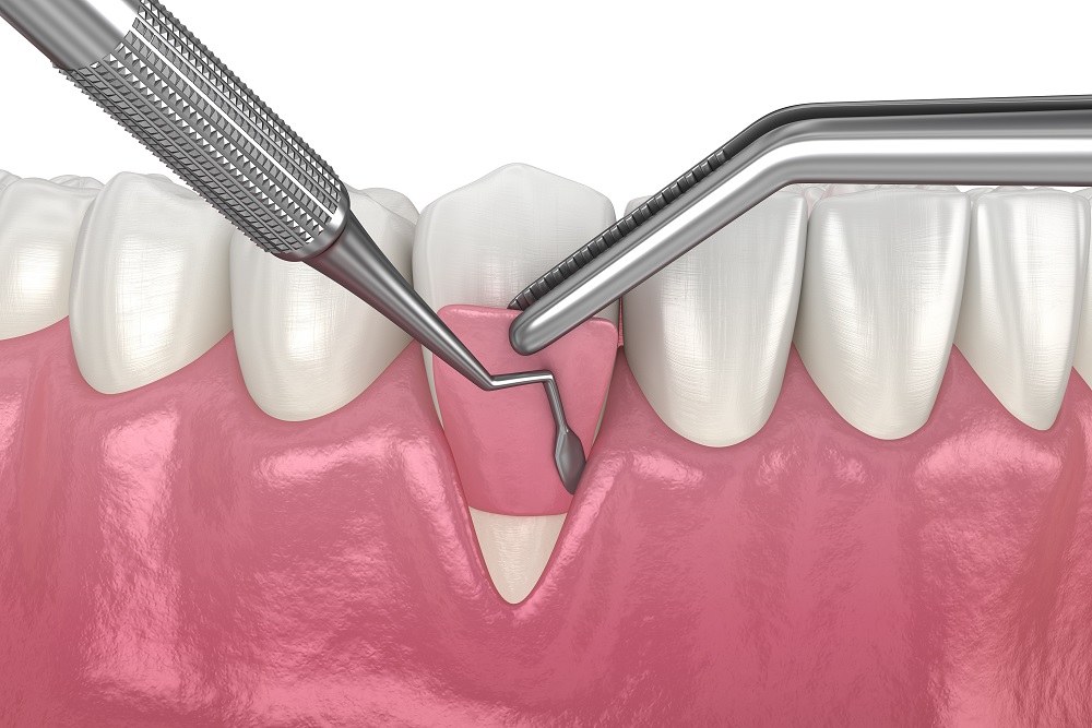 When Is Gum Graft Surgery Necessary?