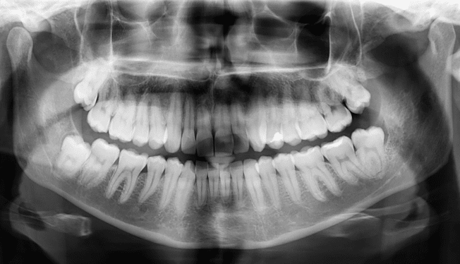 Wisdom Teeth X-rays In Grande Prairie